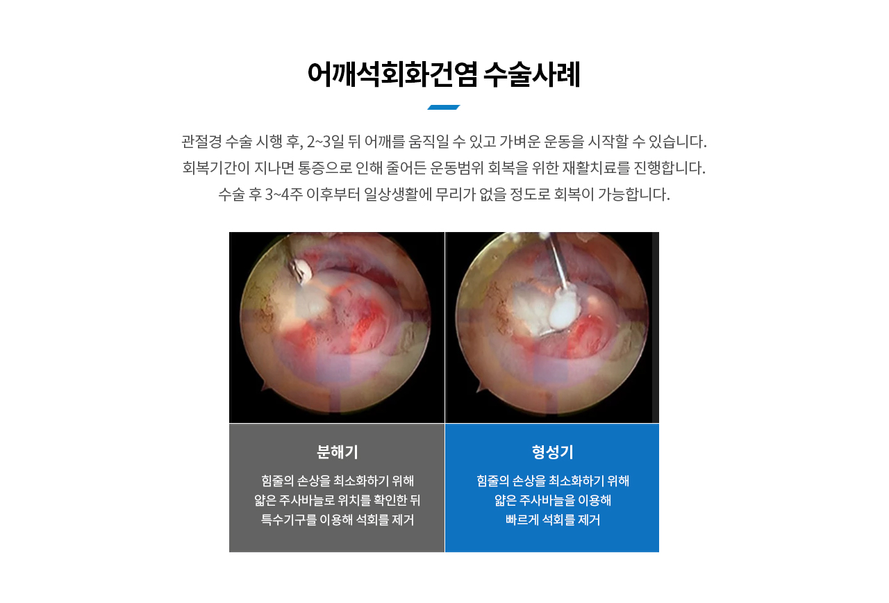 어깨석회화건염 수술사례